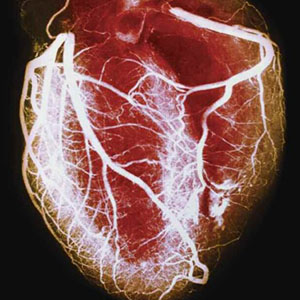 This angiogram, an X-ray technique using an injected dye, reveals a healthy human heart. 